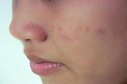 80 بالمائة من شباب الجزائر يعانون من حب الشباب