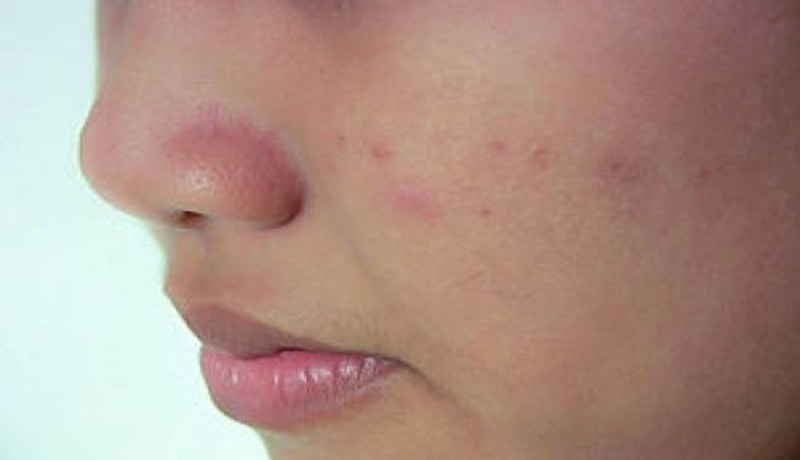 80 بالمائة من شباب الجزائر يعانون من حب الشباب