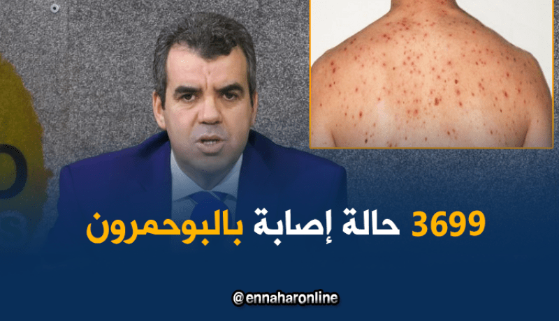 وزارة الصحة: عدم احترام رزنامة التلقيح سبب الإصابة بالبوحمرون