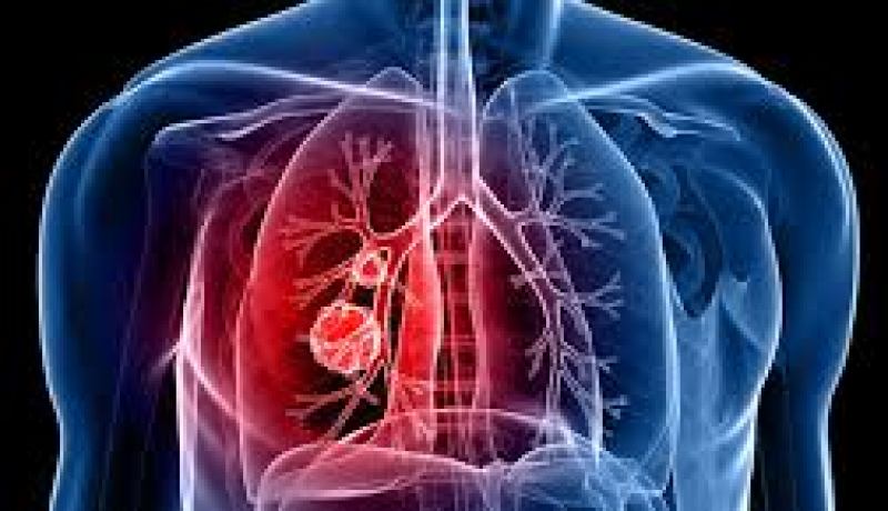 تقنية جديدة للتشخيص المبكر لسرطانات الرئة تدخل مستشفى وهران