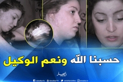 بالفيديو.. معاناة شهرة والسبب طليقها الذي اعتدى عليها بحمض الأسيد