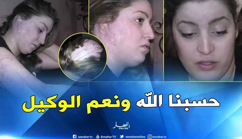 بالفيديو.. معاناة شهرة والسبب طليقها الذي اعتدى عليها بحمض الأسيد