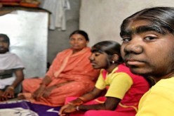 3 شقيقات مصابات بمرض متلازمية الذئب يتمسكن بحلم الزواج