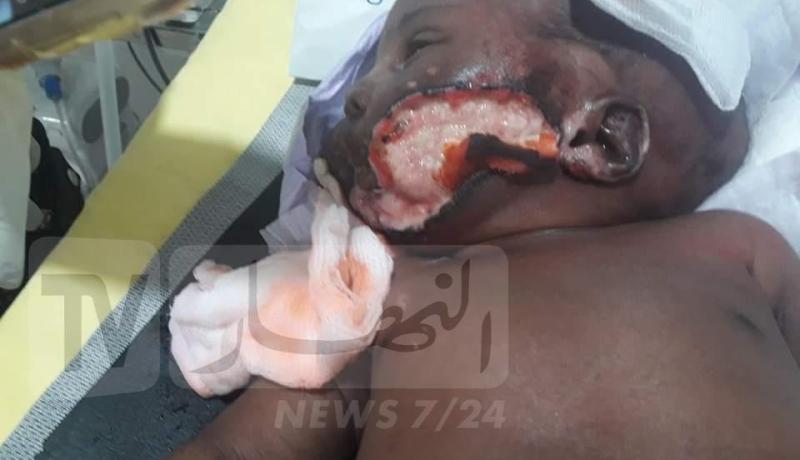 مولود يتعرض لتشوهات بسبب الطاقم الطبي بغرداية