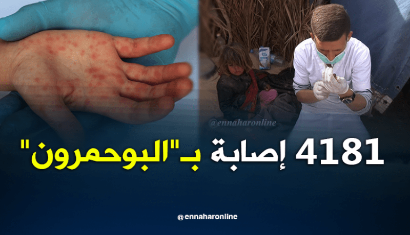تسجيل 4181 حالة إصابة بـ”البوحمرون” على المستوى الوطني
