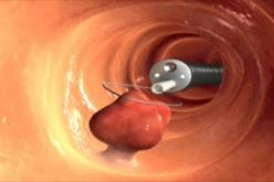 1260 اصابة بسرطان الكولون بتيزي وزو