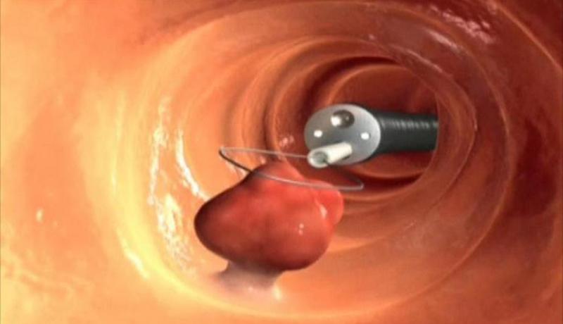 1260 اصابة بسرطان الكولون بتيزي وزو
