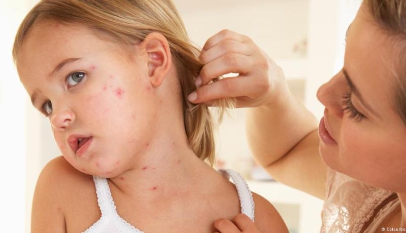 أرقام مخيفة لانتشار مرض الحصبة في أوروبا