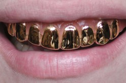 قطرية تدخل “غينيس” بأغلى ابتسامة من الذهب والألماس