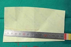 دودة تعيش في رأس امرأة في الصين