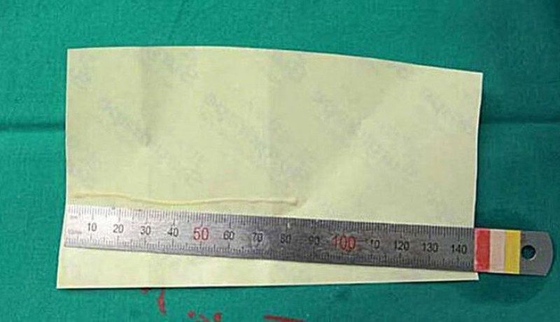 دودة تعيش في رأس امرأة في الصين