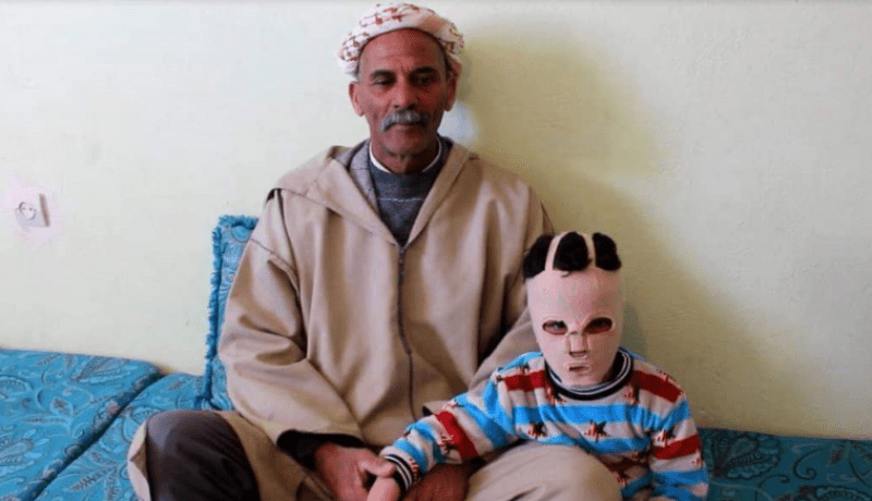 بالصور: الطفل عماد بحاجة لعملية جراحية على مستوى الوجه بالنعامة