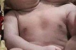 ولادة طفلة برأسين في أغرب حالة في العالم