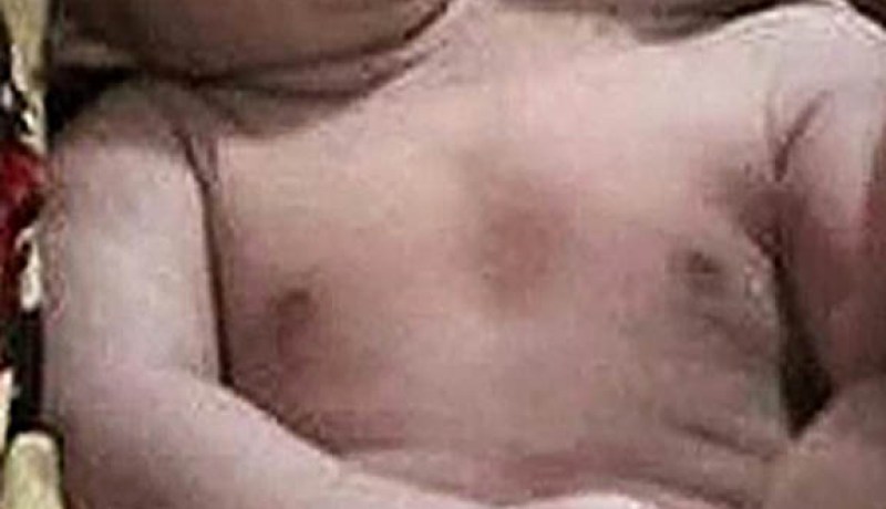 ولادة طفلة برأسين في أغرب حالة في العالم