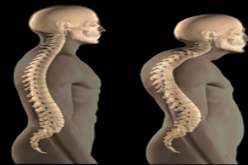 عقار للوقاية من سرطان الثدي يسبب هشاشة العظام