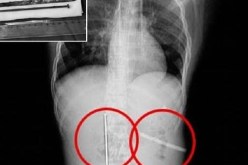 شاب صيني يبتلع مسماراً طوله 12 سنتيمتراً ليربح 6 آلاف يوان