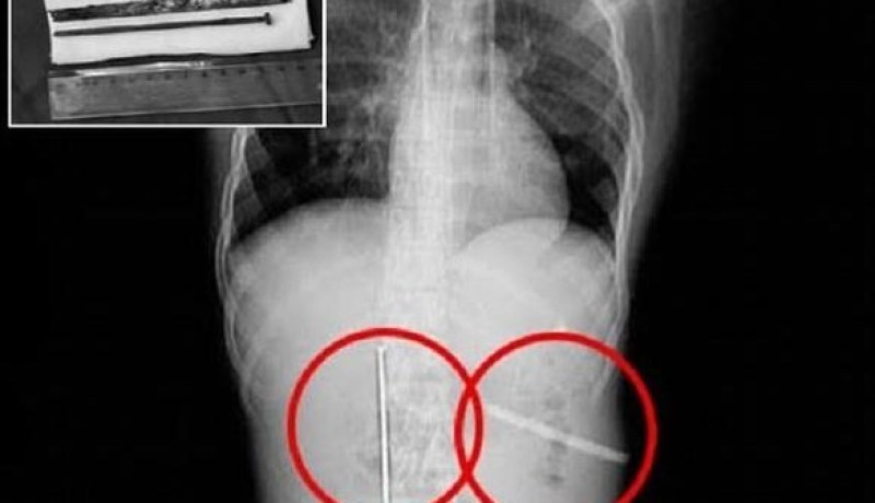 شاب صيني يبتلع مسماراً طوله 12 سنتيمتراً ليربح 6 آلاف يوان