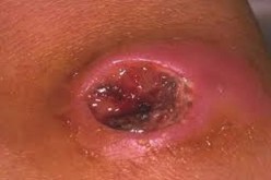 حالة طوارئ بعد وفاة شخصين واصابة 67 آخرين بالجمرة الخبيثة في زامبيا