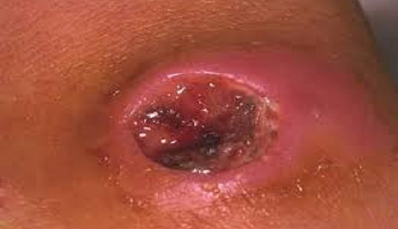 حالة طوارئ بعد وفاة شخصين واصابة 67 آخرين بالجمرة الخبيثة في زامبيا