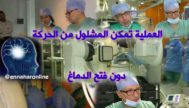 أول عملية بالجزائر لعلاج العاهات بأوعية المخ دون فتح الدماغ