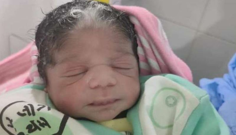 مصر.. ولادة طفلة بشعر أبيض والأطباء يُحددون السبب