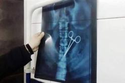 بالصورة طبيب ينسى مقص داخل معدة مريض