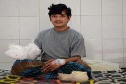 بالفيديو.. 16 عملية جراحية للرجل الشجرة لإستعادة حياته الطبيعية