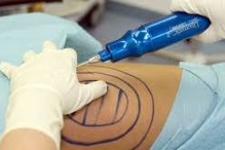 شفط الدهون لتجميل الشكل أم لتخفيف الوزن ؟