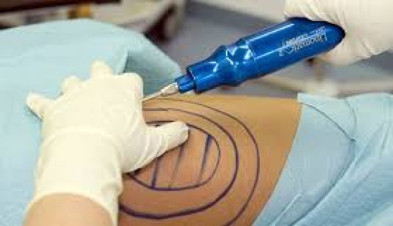 شفط الدهون لتجميل الشكل أم لتخفيف الوزن ؟