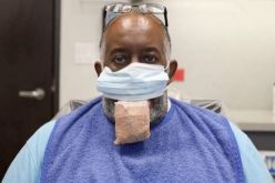 مضاعفات خطيرة لكورونا تُذهل الأطباء.. تضخم مُرعب للسان!