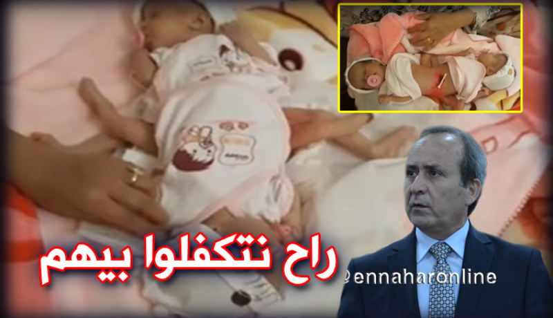 وزارة الصحة تتكفل بالتوأم السيامي بميلة