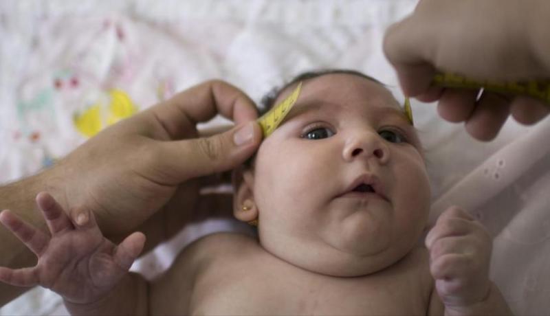 الطب البرازيلي يكشف وجود علاقة بين زيكا و مرض صغر الرأس عند الرضع