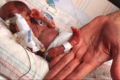 معجزة بشرية ولادة طفلة وزنها 500 غرام