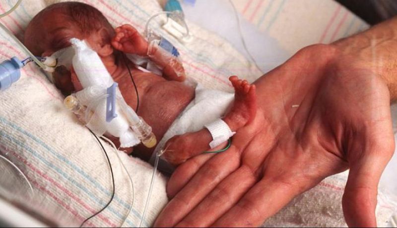 معجزة بشرية ولادة طفلة وزنها 500 غرام