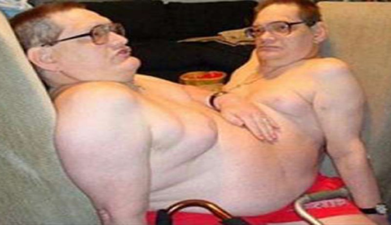 أكبر توأمين ملتصقين يعيشان بجسد واحد منذ 58 عاماً