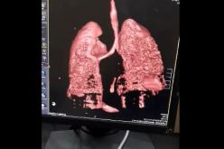 فيديو صادم لمصاب جزائري.. هذا حجم الضرر الذي يسببه كورونا للرئتين