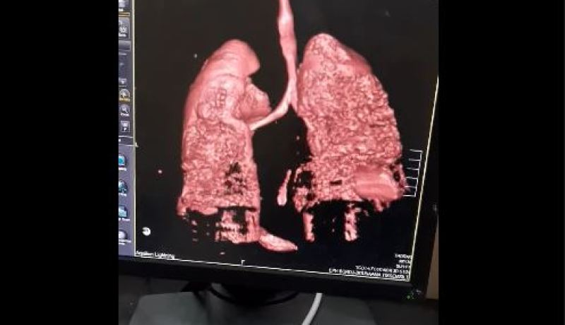 فيديو صادم لمصاب جزائري.. هذا حجم الضرر الذي يسببه كورونا للرئتين