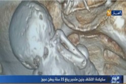 بالفيديو …إكتشاف جنين متحجر لمدة 35 سنة ببطن عجوز بسكيكدة