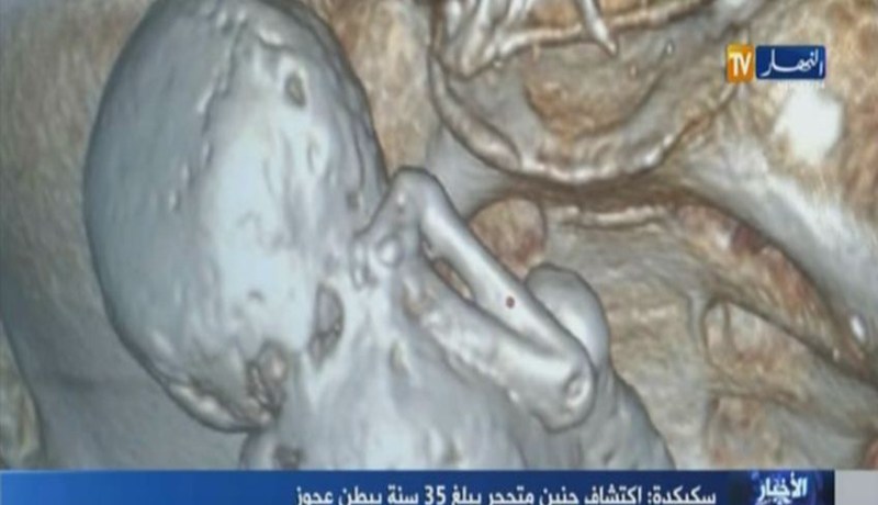 بالفيديو …إكتشاف جنين متحجر لمدة 35 سنة ببطن عجوز بسكيكدة
