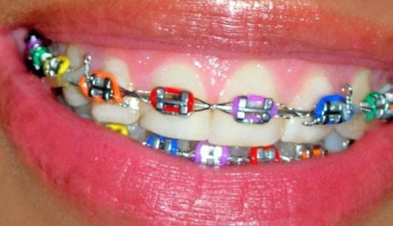 لن أكون جميلة دون آلة تقويم الأسنان.. لكنّي لا أتقبل وضعها
