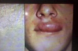 وباء “شاغاس” يصيب 300 ألف أميركي وتحذيرات من إنتشاره  