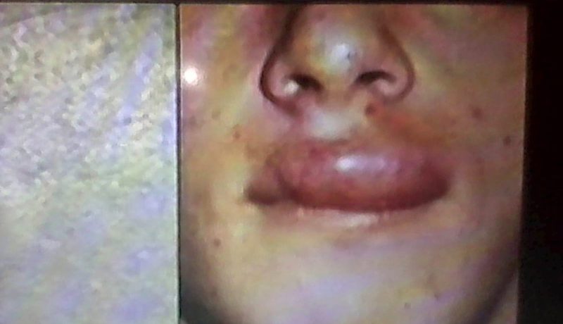 وباء “شاغاس” يصيب 300 ألف أميركي وتحذيرات من إنتشاره  