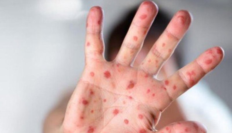 «بوحمرون» يقتل طفلا ويصيب 19 شخصا في تبسة