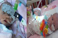 أصغر طفلة في العالم تتعافى من جراحة قلب مفتوح