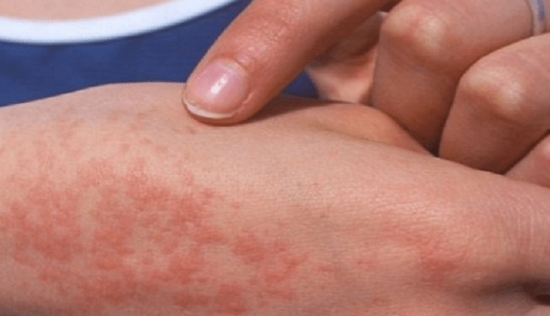 ارتفاع حالات الإصابة بـ”الحمى المالطية” إلى 40 حالة في “آريس” بباتنة