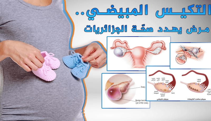 التكيس المبيضي عند النساء وتأثيره على الحمل