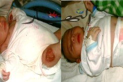 رضّع مهدّدون ببتر الساق بسبب لقاح مشبوه