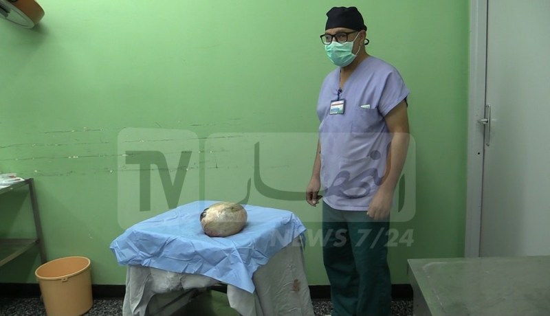 بالصور.. فريق طبي شاب ينجح في استئصال ورم كيسي وزنه 4 كلغ من بطن عجوز بباتنة