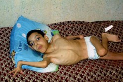 أصيب بإعاقة تامة بعد أن اعترته الحمى : عبد القادر.. 13 عاما من المعاناة ينتظر التفاتة