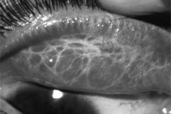 تسبب فيها ارتفاع الحرارة وانعدام النظافة : انتشار رهيب لمرض الرمد الحبيبي بالجلفة